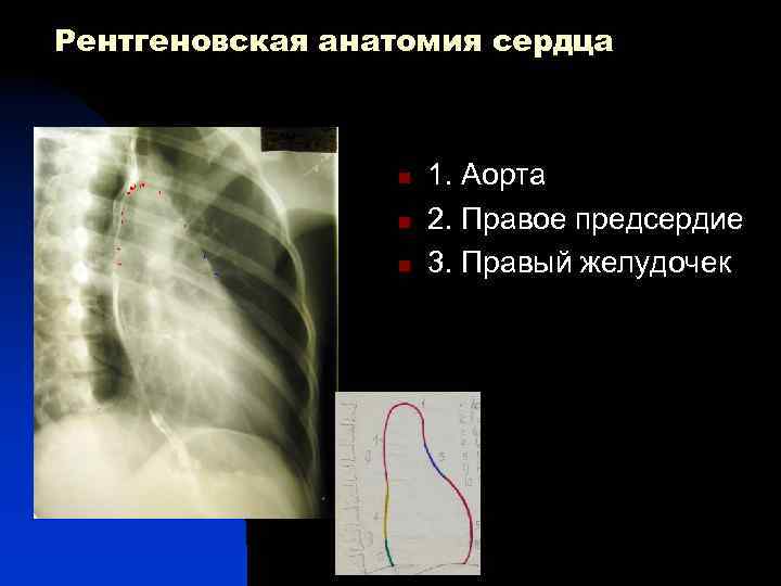 Рентгеновская анатомия сердца 1 n n 3 n 5 7 1. Аорта 2. Правое