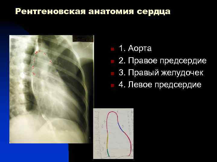 Рентгеновская анатомия сердца 1 n n 3 n n 5 7 1. Аорта 2.