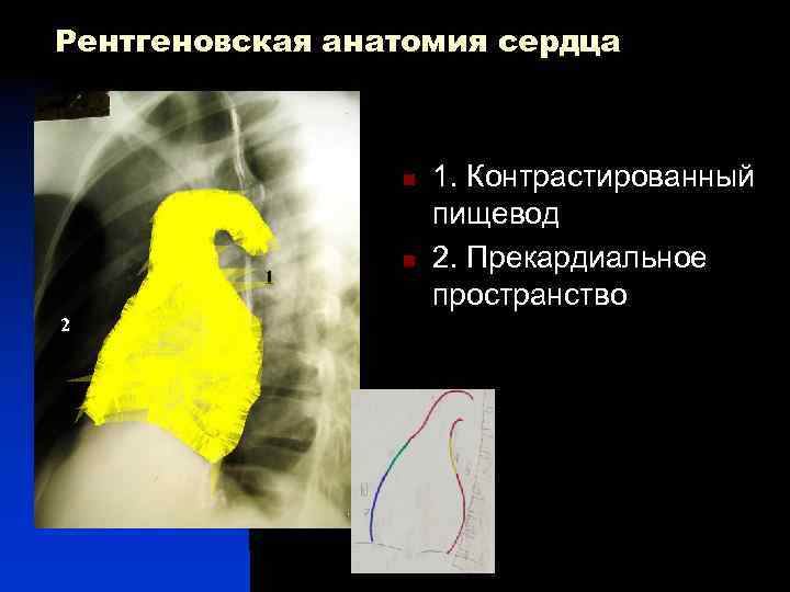 Рентгеновская анатомия сердца 11 n 4 n 1 2 5 7 1. Контрастированный пищевод