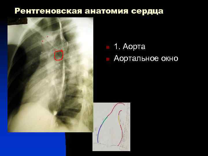 Рентгеновская анатомия сердца 1 n n 4 1 5 7 1. Аортальное окно 