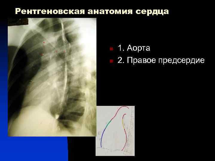 Рентгеновская анатомия сердца 1 n n 4 1 5 7 1. Аорта 2. Правое