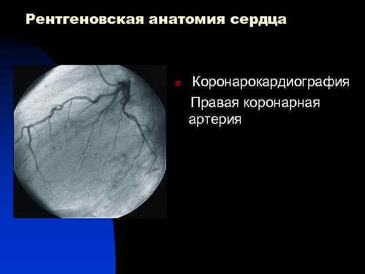 Рентгеновская анатомия сердца n Коронарокардиография Правая коронарная артерия 