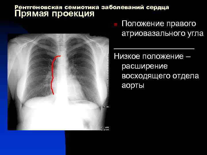Рентгеновская семиотика заболеваний сердца Прямая проекция Положение правого атриовазального угла _________ Низкое положение –