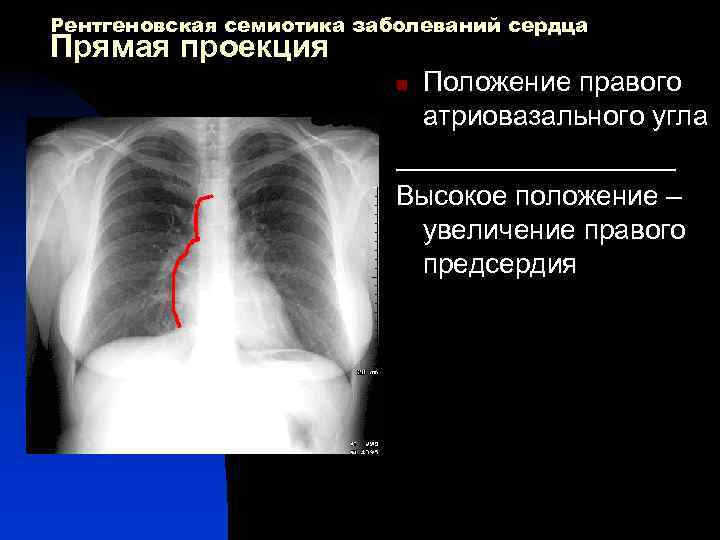 Рентгеновская семиотика заболеваний сердца Прямая проекция Положение правого атриовазального угла _________ Высокое положение –