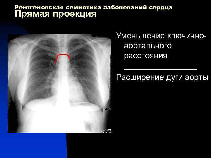 Рентгеновская семиотика заболеваний сердца Прямая проекция Уменьшение ключично аортального расстояния ________ Расширение дуги аорты