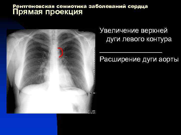 Рентгеновская семиотика заболеваний сердца Прямая проекция Увеличение верхней дуги левого контура ________ Расширение дуги