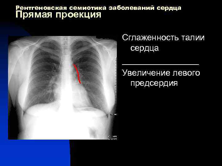 Рентгеновская семиотика заболеваний сердца Прямая проекция Сглаженность талии сердца ________ Увеличение левого предсердия 