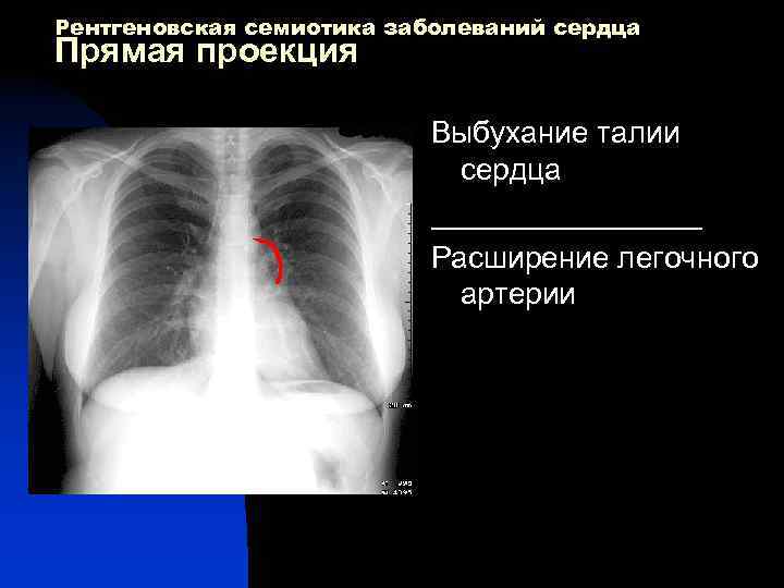Рентгеновская семиотика заболеваний сердца Прямая проекция Выбухание талии сердца ________ Расширение легочного артерии 