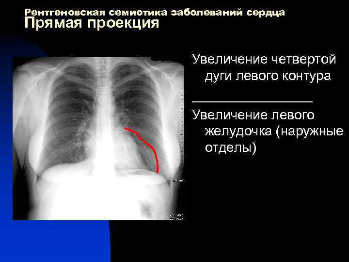 Рентгеновская семиотика заболеваний сердца Прямая проекция Увеличение четвертой дуги левого контура ________ Увеличение левого