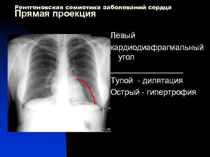 Рентгеновская семиотика заболеваний сердца Прямая проекция Левый кардиодиафрагмальный угол ________ Тупой дилятация Острый гипертрофия