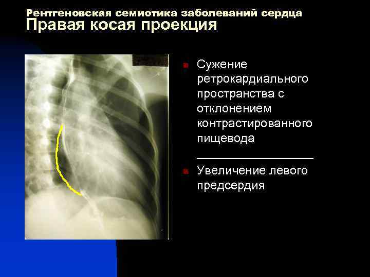 Рентгеновская семиотика заболеваний сердца Правая косая проекция n n Сужение ретрокардиального пространства с отклонением