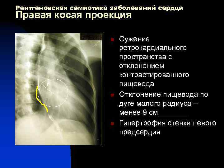 Рентгеновская семиотика заболеваний сердца Правая косая проекция n r n n Сужение ретрокардиального пространства