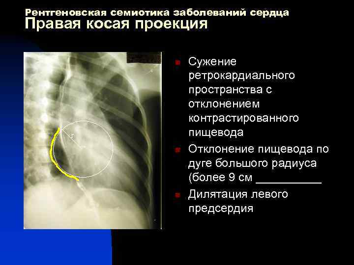 Рентгеновская семиотика заболеваний сердца Правая косая проекция n r n n Сужение ретрокардиального пространства