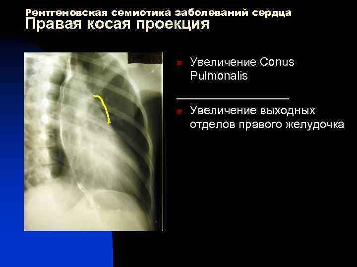Рентгеновская семиотика заболеваний сердца Правая косая проекция Увеличение Conus Pulmonalis _________ n Увеличение выходных