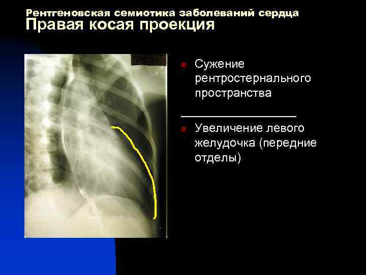 Рентгеновская семиотика заболеваний сердца Правая косая проекция Сужение рентростернального пространства _________ n Увеличение левого