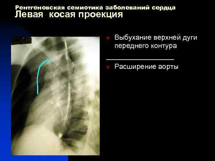 Рентгеновская семиотика заболеваний сердца Левая косая проекция Выбухание верхней дуги переднего контура _________ n