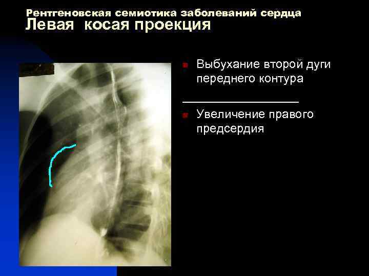 Рентгеновская семиотика заболеваний сердца Левая косая проекция Выбухание второй дуги переднего контура _________ n