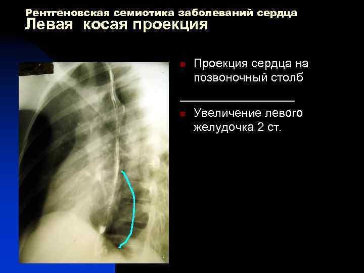 Рентгеновская семиотика заболеваний сердца Левая косая проекция Проекция сердца на позвоночный столб _________ n