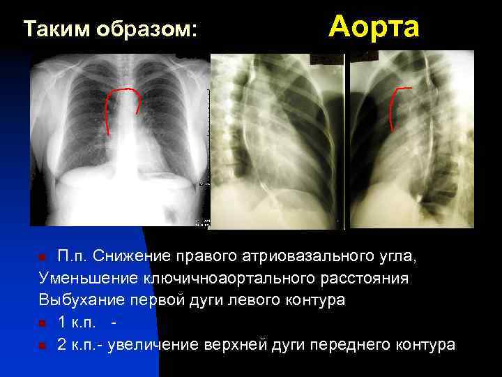 Таким образом: Аорта П. п. Снижение правого атриовазального угла, Уменьшение ключичноаортального расстояния Выбухание первой