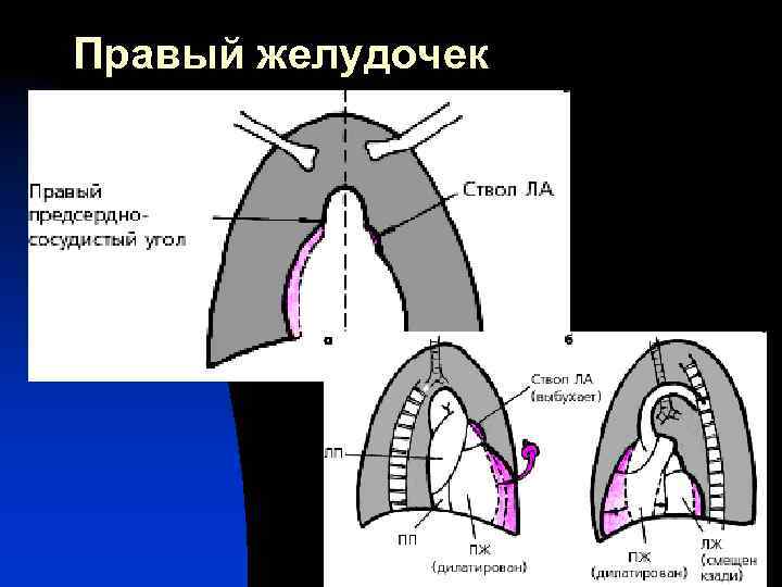 Правый желудочек 