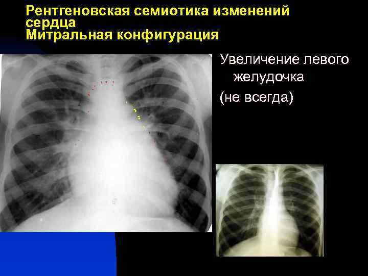 Рентгеновская семиотика изменений сердца Митральная конфигурация Увеличение левого желудочка (не всегда) 