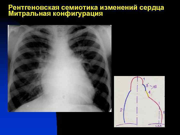 Рентгеновская семиотика изменений сердца Митральная конфигурация 