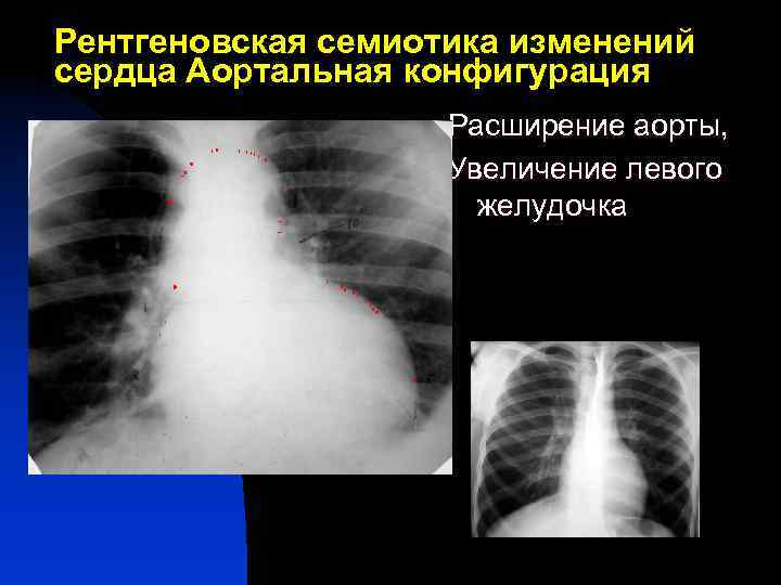Рентгеновская семиотика изменений сердца Аортальная конфигурация Расширение аорты, Увеличение левого желудочка 