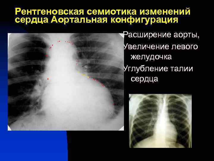 Рентгеновская семиотика изменений сердца Аортальная конфигурация Расширение аорты, Увеличение левого желудочка Углубление талии сердца
