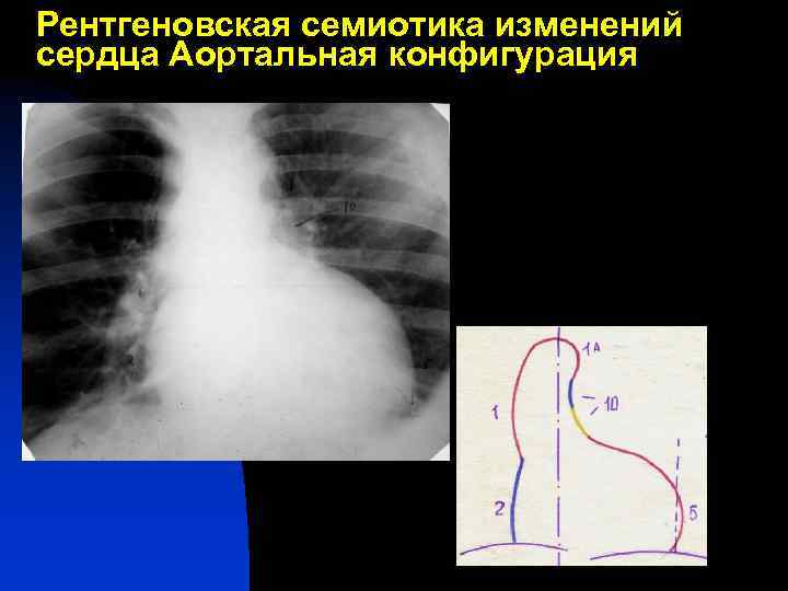 Рентгеновская семиотика изменений сердца Аортальная конфигурация 
