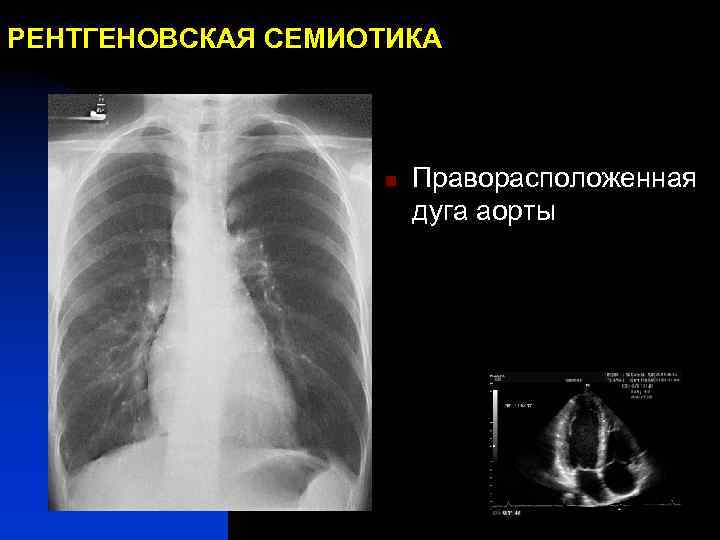 РЕНТГЕНОВСКАЯ СЕМИОТИКА n Праворасположенная дуга аорты 