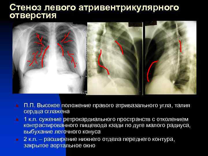 Стеноз левого атривентрикулярного отверстия n n n П. П. Высокое положение правого атривазального угла,