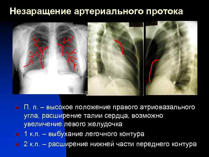 Незаращение артериального протока n n n П. п. – высокое положение правого атриовазального угла,