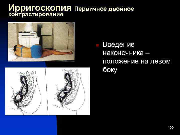 Ирригоскопия что это. Ирригоскопия (контрастирование кишечника). Ирригоскопия методом двойного контрастирования. Двойное контрастирование при ирригоскопии. Первичное двойное контрастирование желудка.