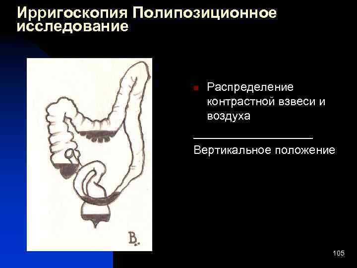 Ирригоскопия это