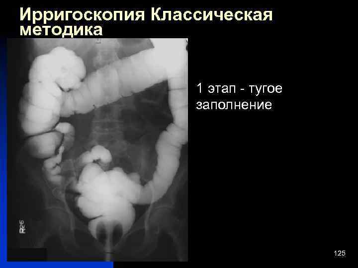 Ирригоскопия подготовка отзывы. Рентгенологическое исследование Толстого кишечника (ирригоскопия).. Ирригоскопия опухоль сигмовидной кишки. Ирригоскопия двойное контрастирование.