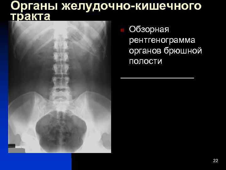 Обзорная рентгенография. Обзорная рентгенограмма органов ЖКТ. Почки на обзорной рентгенограмме органов брюшной полости. Обзорная рентгенография органов брюшной полости методика проведения. Обзорная рентгенография брюшной полости ЖКТ.