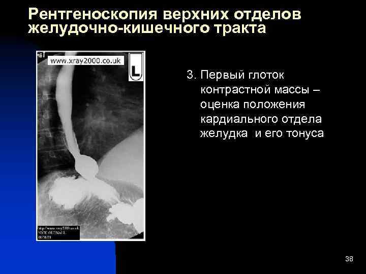 При рентгеноскопии изображение получается