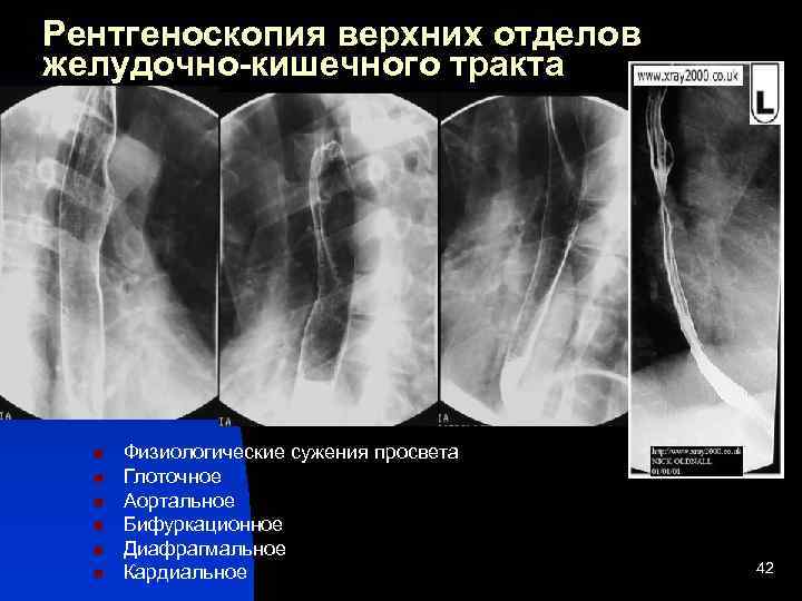 Рентгеноскопия пищевода и желудка. Рентгенография верхних отделов ЖКТ. Рентгеноскопия. Рентгеноскопия органов ЖКТ. Рентгеноскопия верхних отделов пищеварительного тракта.