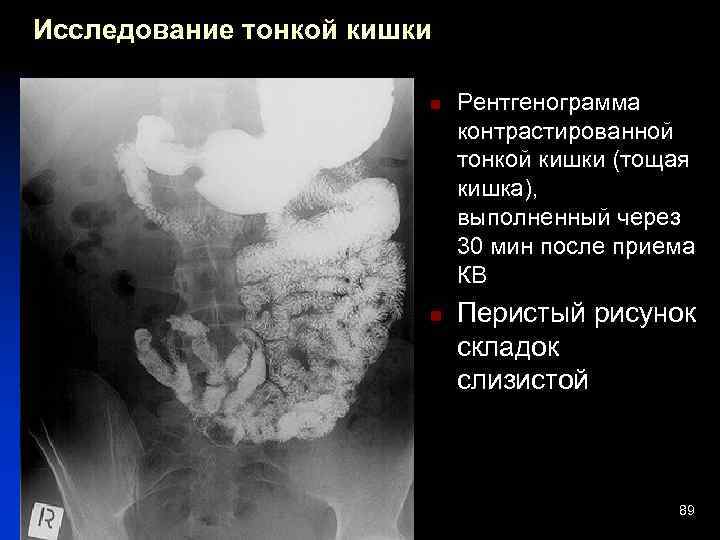 Исследование тонкой кишки