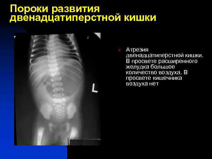 Пороки развития двенадцатиперстной кишки n Атрезия двенадцатиперстной кишки. В просвете расширенного желудка большое количество