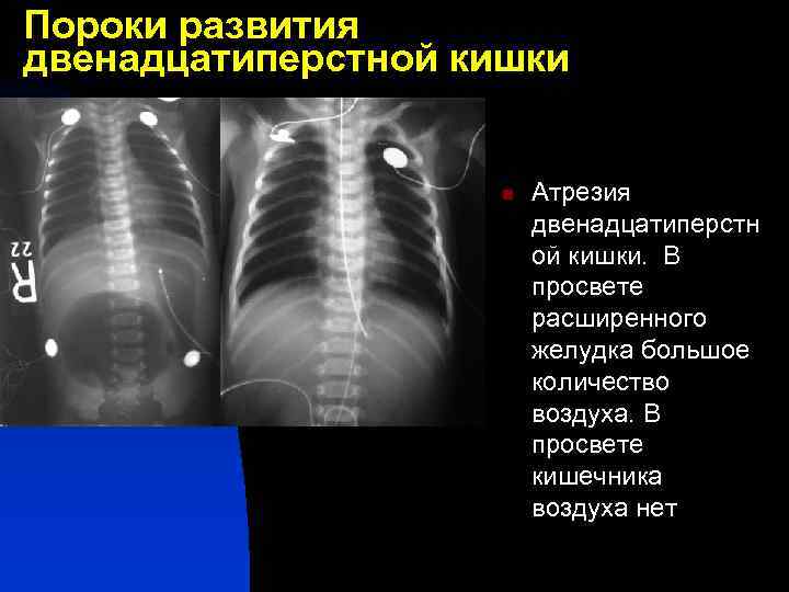 Пороки развития двенадцатиперстной кишки n Атрезия двенадцатиперстн ой кишки. В просвете расширенного желудка большое