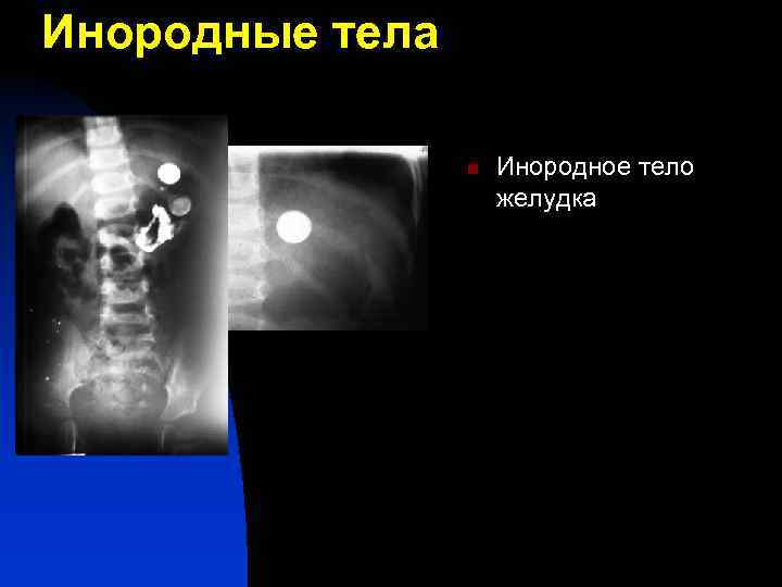 Инородное тело желудка карта вызова