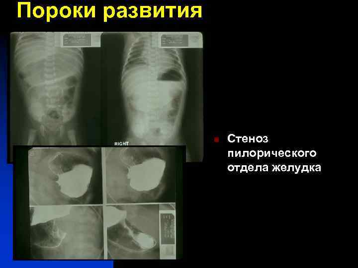 Пороки развития n Стеноз пилорического отдела желудка 