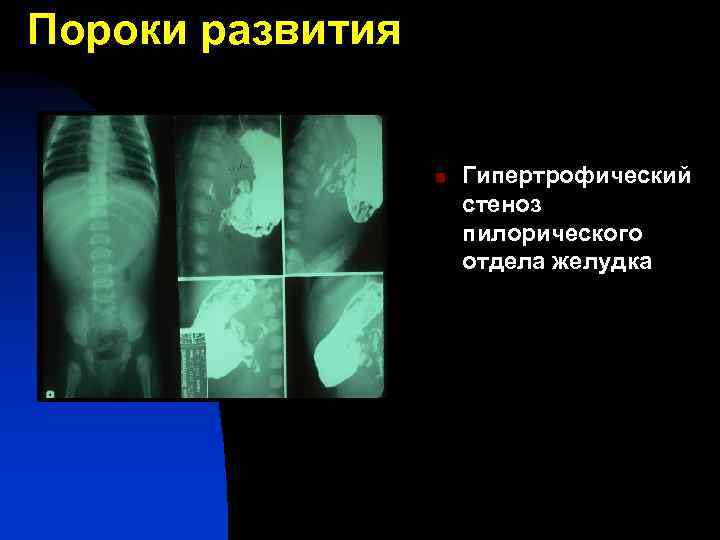 Пороки развития n Гипертрофический стеноз пилорического отдела желудка 