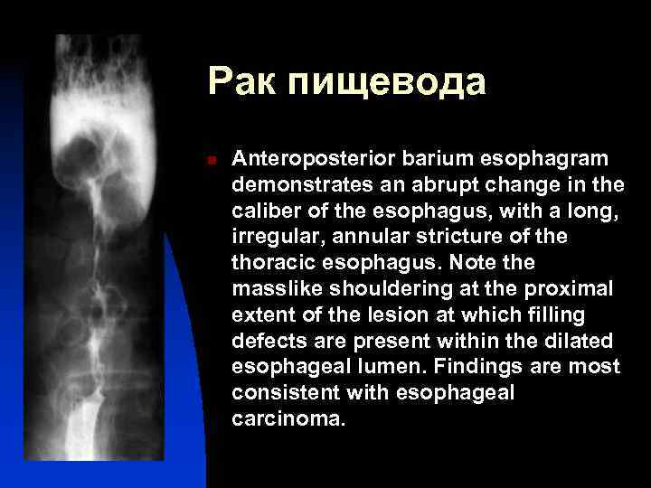 Рак пищевода n Anteroposterior barium esophagram demonstrates an abrupt change in the caliber of