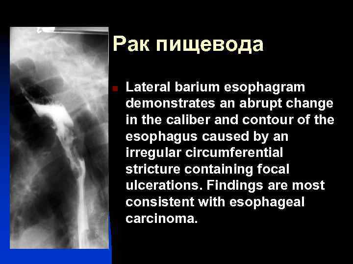Рак пищевода n Lateral barium esophagram demonstrates an abrupt change in the caliber and