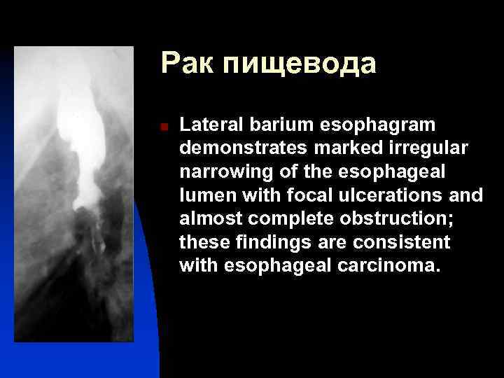 Рак пищевода n Lateral barium esophagram demonstrates marked irregular narrowing of the esophageal lumen