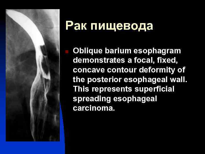 Рак пищевода n Oblique barium esophagram demonstrates a focal, fixed, concave contour deformity of