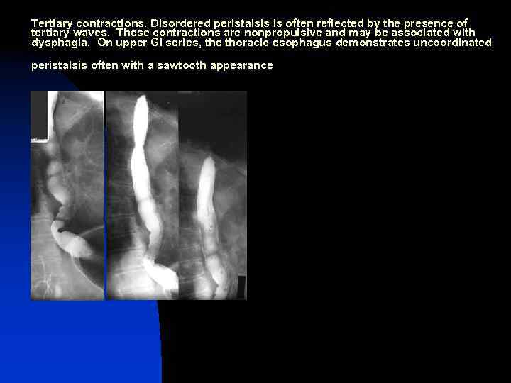 Tertiary contractions. Disordered peristalsis is often reflected by the presence of tertiary waves. These