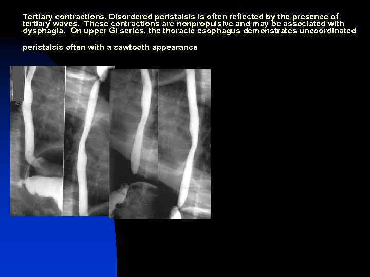 Tertiary contractions. Disordered peristalsis is often reflected by the presence of tertiary waves. These